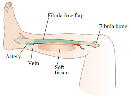 Figure 1. Fibula free flap