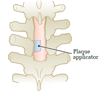 Figure 2. Plaque applicator on spine